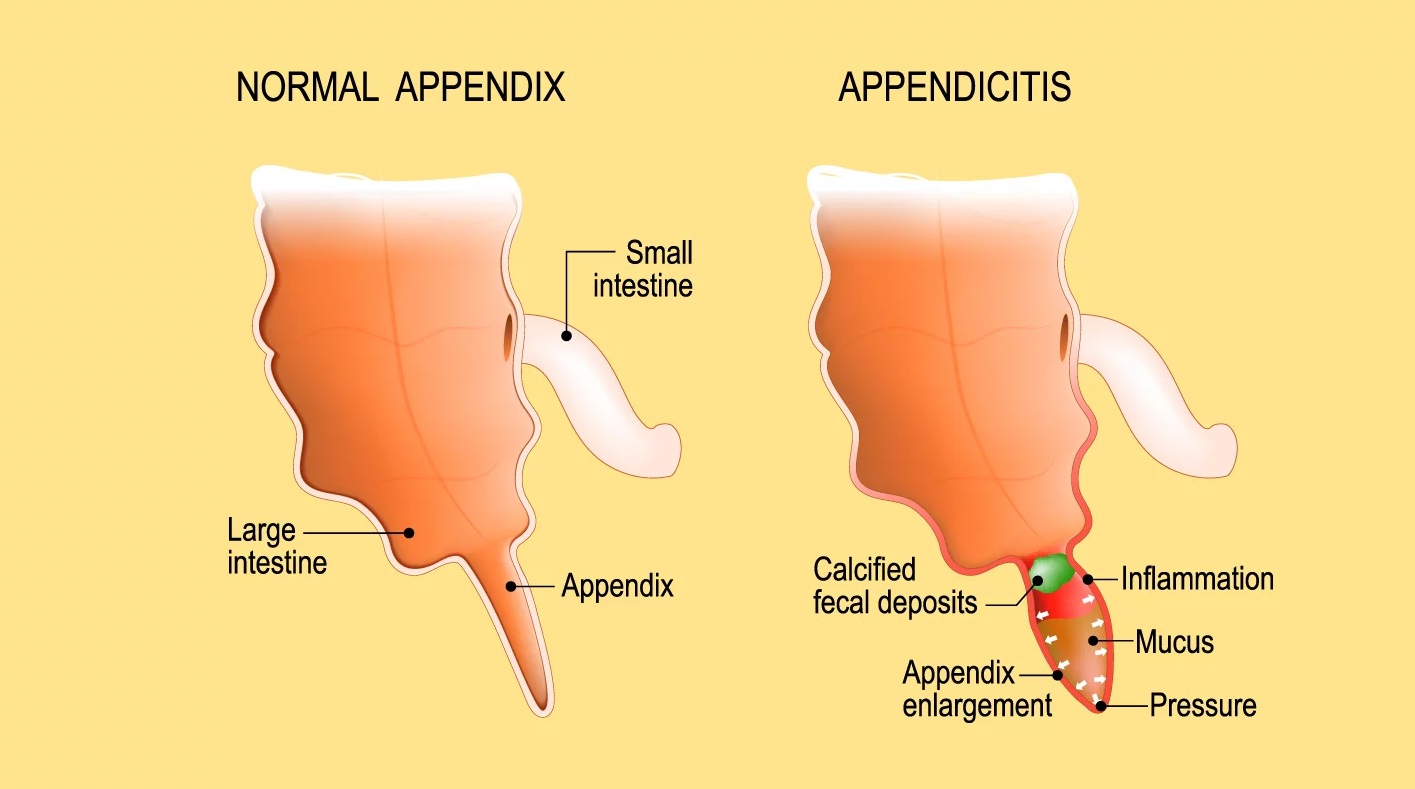 Appendicitis - Best Gastro Surgeon Ahmedabad, Best Gatroenterologist