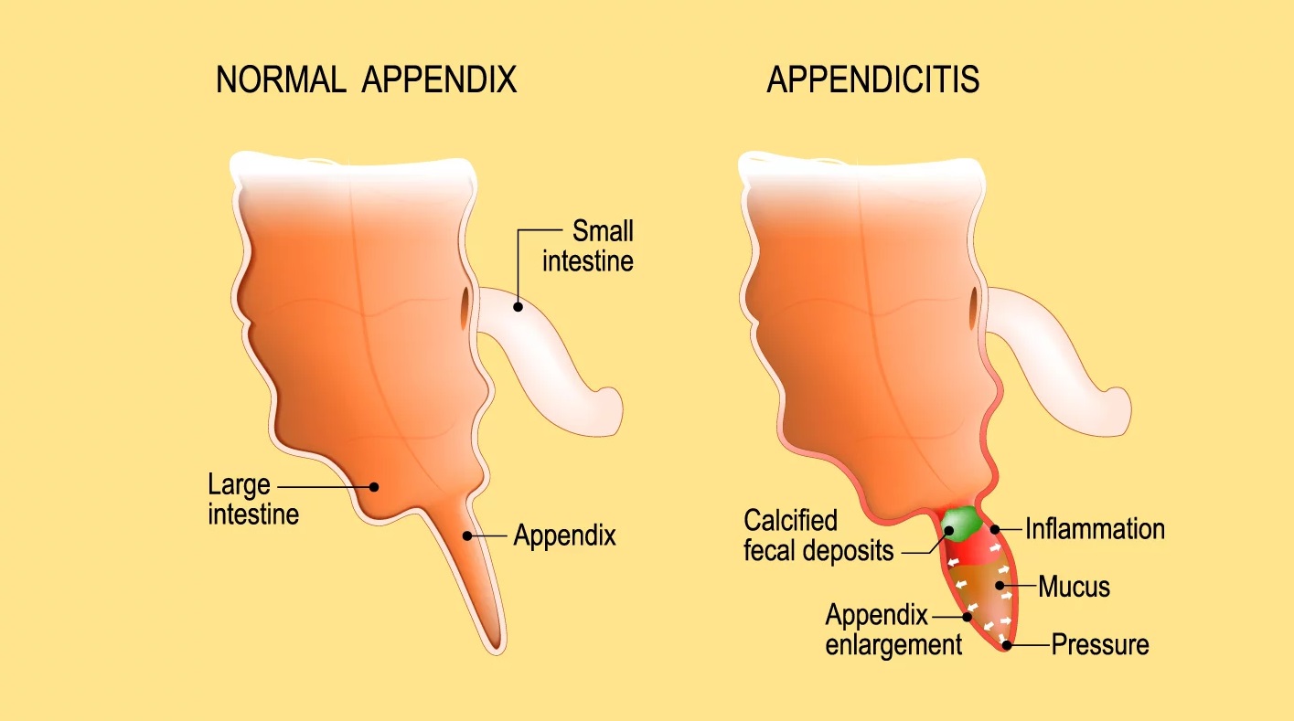 Can I Have Coffee After An Appendectomy