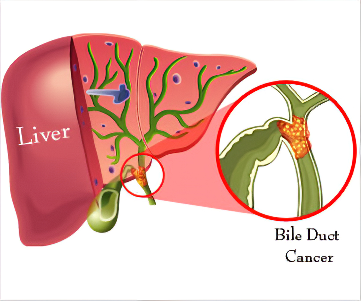Bile Duct Cancer Surgery