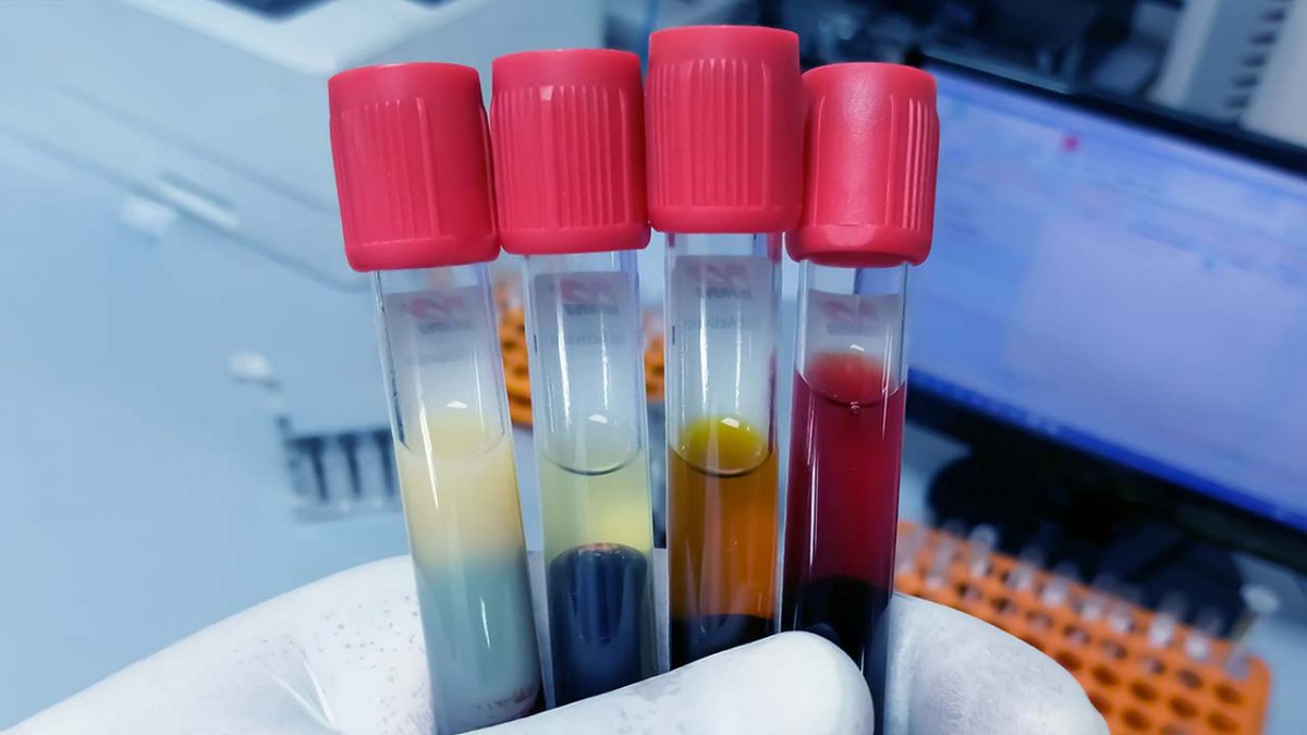 Bilirubin Blood Test- Procedure, Risks and Results