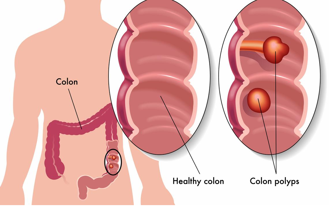 surgical removal of colon polyps