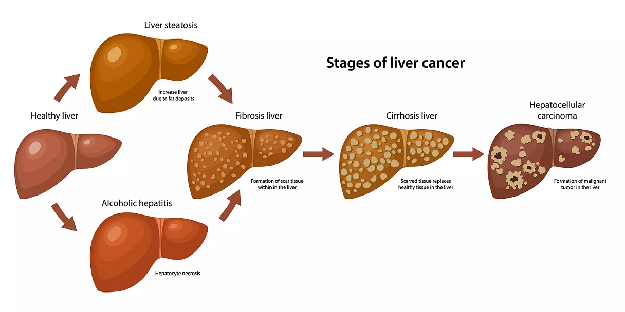 Liver Cancer Diagnosis and Staging | Best Gastro Surgeon Ahmedabad ...
