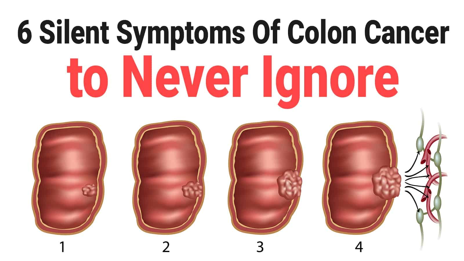 symptoms of colon rectum cancer