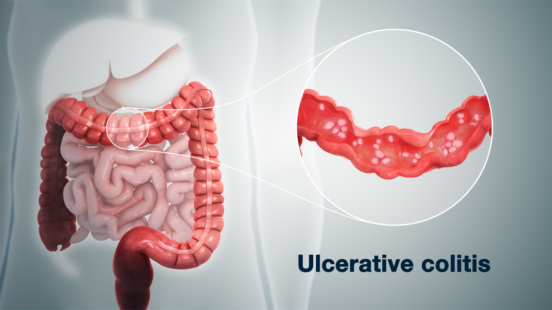 Ulcerative Colitis, Best Gastroenterologist in Ahmedabad, India, Good  Gastroenterologist in Ahmedabad