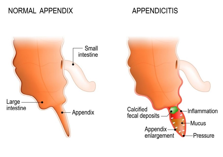 Appendix Surgery
