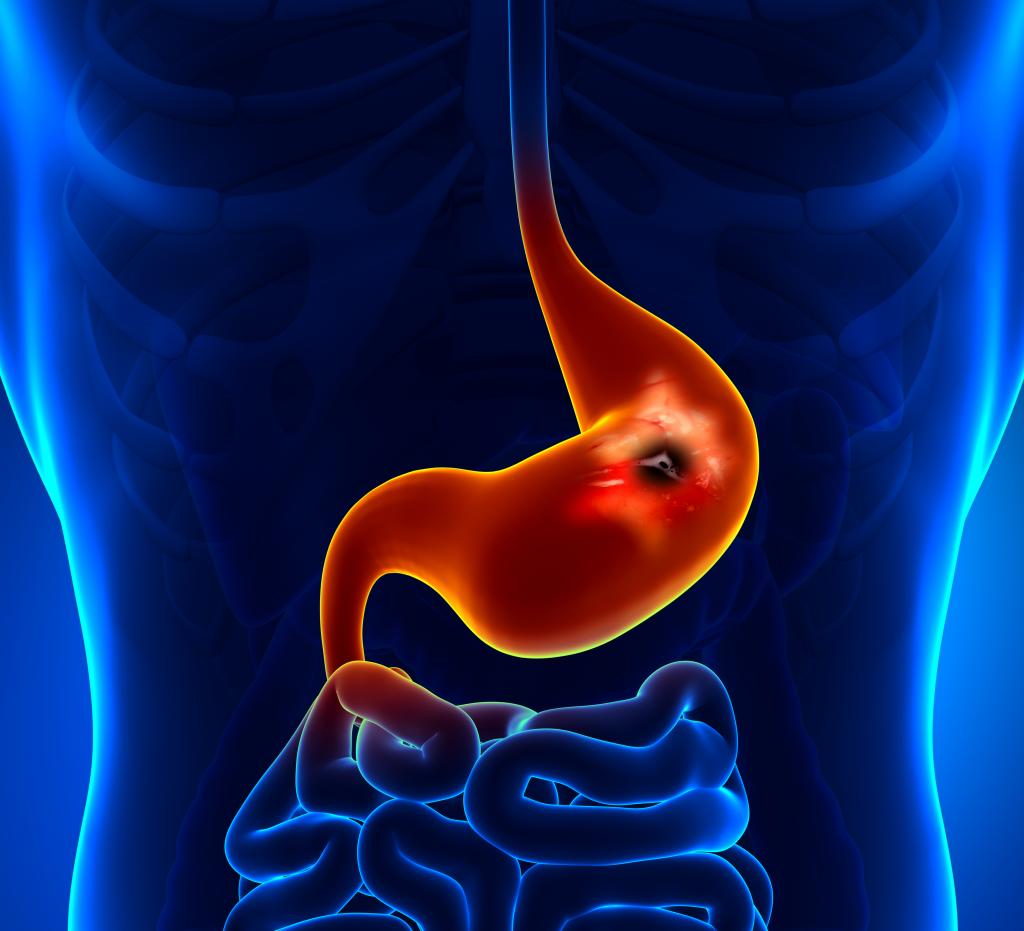 Stomach Cancer- What it is and what are its risk factors